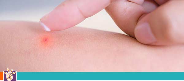 Bug Bites and Stings Treatment for Children in Scottsdale, AZ and Glendale, AZ