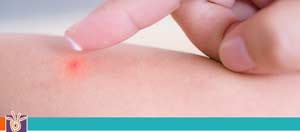 Bug Bites and Stings Treatment for Children in Scottsdale, AZ and Glendale, AZ