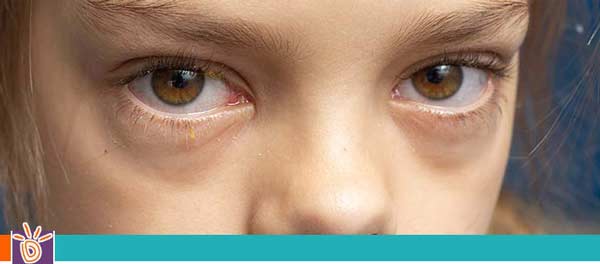Pediatric Conjunctivitis (Pink Eye) Treatment in Scottsdale, AZ and Glendale, AZ Pediatric Conjunctivitis (Pink Eye) Treatment in Scottsdale, AZ and Glendale, AZ