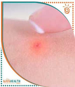 Bug Bites and Stings Treatment Near Me for Children in Scottsdale, AZ