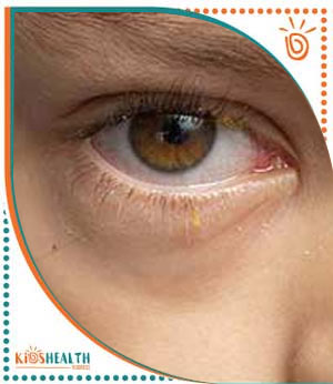 Pediatric Conjunctivitis (Pink Eye) Treatment Specialist Near Me in Scottsdale, and Glendale AZ