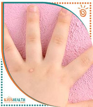 Pediatric Wart Treatment Specialist Near Me in Scottsdale and Glendale AZ